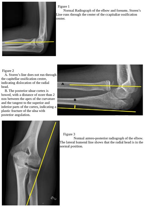 Radial Head Dislocation Article