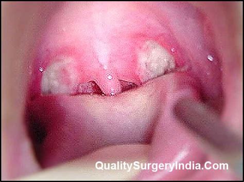 Removing Tonsils In Adult
