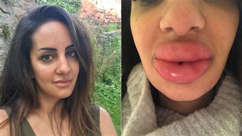 Dentist Left With Swollen Lumps In Lips After Seeking Cheap Fillers