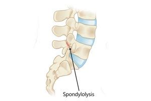 In general, a slipped disc surgery costs around $1,400 to $2,200 in iran. Minimal Invasive Spine Surgery | Slip Disc | Jalandhar