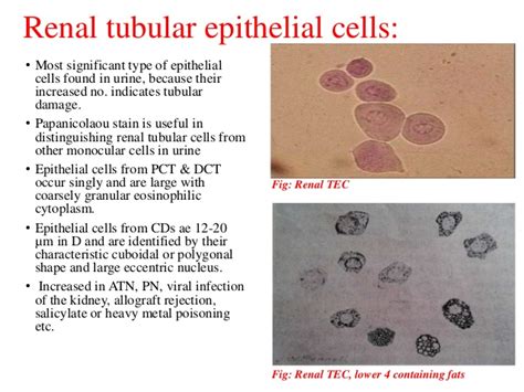 Pus cells are made up of dead white urinary tract infections are best treated with antibiotics. Microscope Transitional Epithelial Cells In Urine - Micropedia