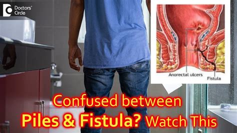 Are Piles And Fistula The Same Dr Rajasekhar M R Doctors Circle