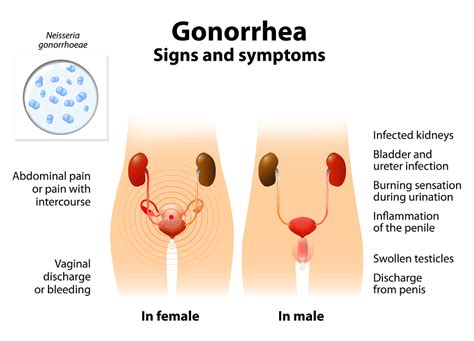 And gonorrhea symptoms in women may be different than in men. Gonorrhea Statistics in the USA | STDAware Blog
