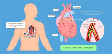 What Is Coronary Artery Bypass Graft Wockhardt Hospitals