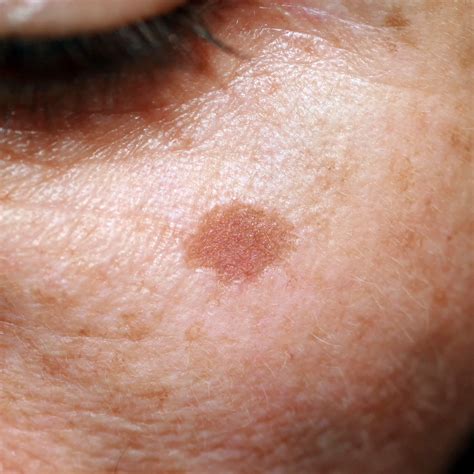 Lentigo Spot Check Skin Cancer Aesthetics Melbourne Cbd