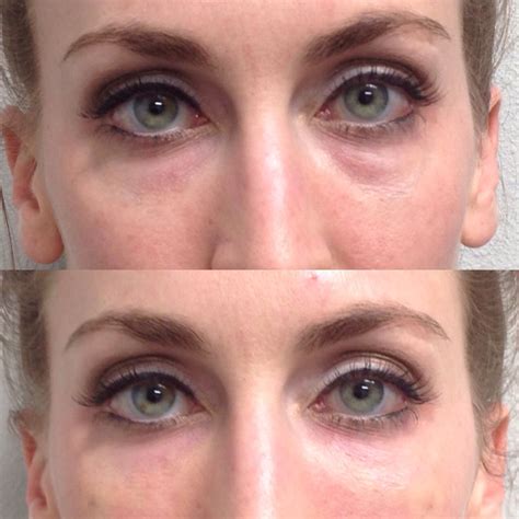 Our Beautiful Adrianne After 1ml Restylane Into Tear Troughs Using
