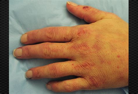 Diagnosing Disorders Of The Hand That Arent Arthritis