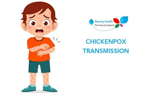 Chickenpox Transmission Its Symptoms And Complications
