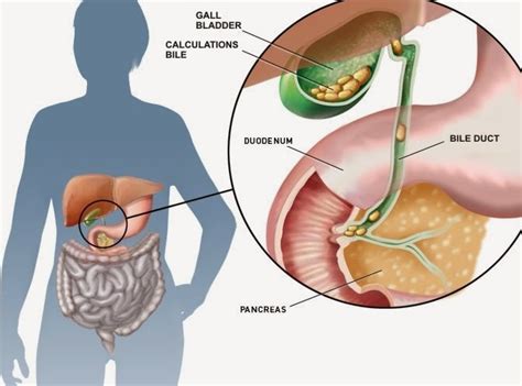Identify the major types of enzymes and buffers present in pancreatic juice. The Health Website : Gallstones