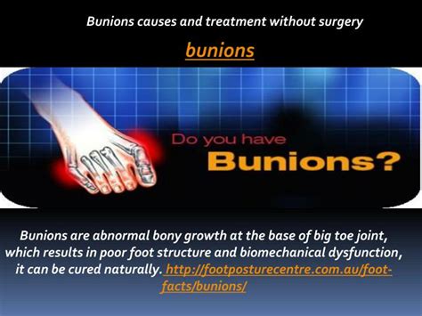 Ppt Bunions Causes And Treatment Without Surgery Powerpoint