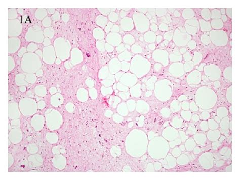 A Well Differentiated Liposarcoma Wdl This Typical Example Shows
