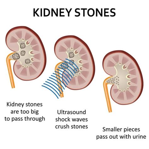How To Help Break Down Kidney Stones