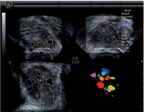 Figure 1 From Ovarian Volume And Antral Follicle Count Assessed By Mri