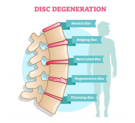 Pain Relief For Herniated Disc Premierechiro