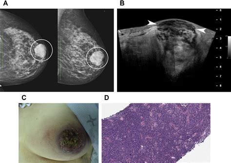 Extranodal Lymphoma Of The Breast Radiologic Clinics