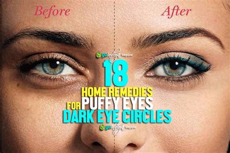 18 Natural Home Remedies For Dark Eye Circles Puffy Eyes Part 2