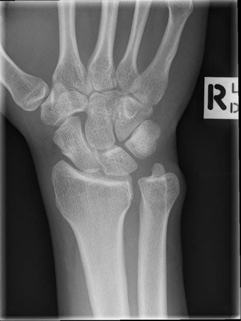 Normal Scaphoid Series Image