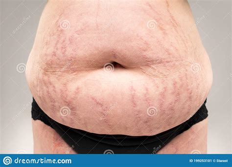 Fat Flabby Female Belly With Stretch Marks On Gray Background Stock Image Image Of Lose Body
