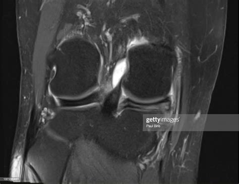 Magnetic Resonance Imaging Mri Knee Posterior Horn Medial Meniscus Tear