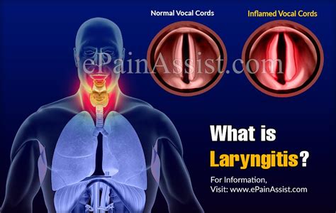 What Is Worse Pharyngitis Or Laryngitis