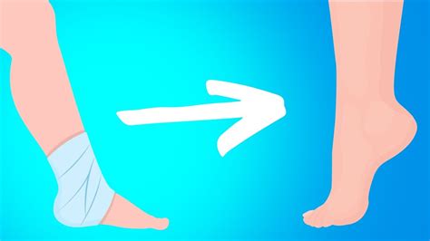 Best Ankle Rehabilitation Exercises For An Ankle Injury Sprain Or