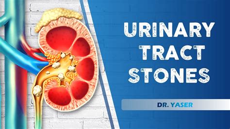 Urinary Tract Stones D Yaser Lecture 4 Youtube