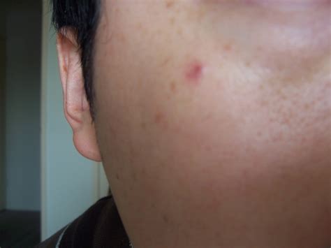 Red Bump On Face
