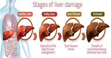 Maybe you would like to learn more about one of these? Liver disease and Symptoms - جگر کے امراض کی چند واضح علامات