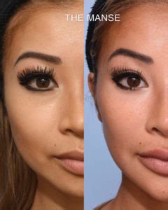 (a brow lift may be required if brow droop is present.). Asian Face Injectables and Laser - Best Clinic Sydney for Dermal Fillers