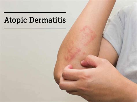 Treatment Of Atopic Dermatitis With Natural Herbal Remedies