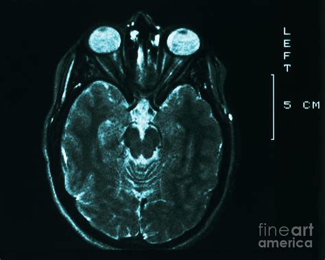 Mri Of Normal Brain Photograph By Science Source Pixels