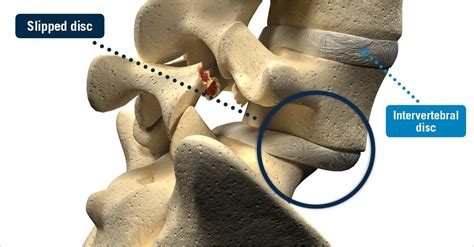 Slipped Disc Usa Spine Care Laser Spine Surgery