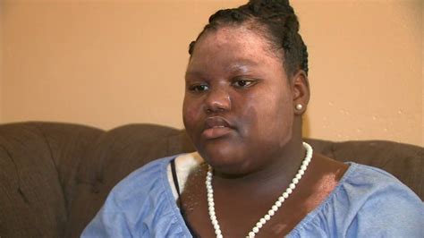 11 Year Old Girl Burned By Boiling Water During Sleepover I Cant Be