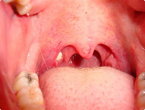 What Herbs Can You Use To Get Rid Of Tonsillitis Faster