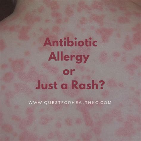 Antibiotic Allergy Or Just A Rash Quest For Health Kc Rash Allergy