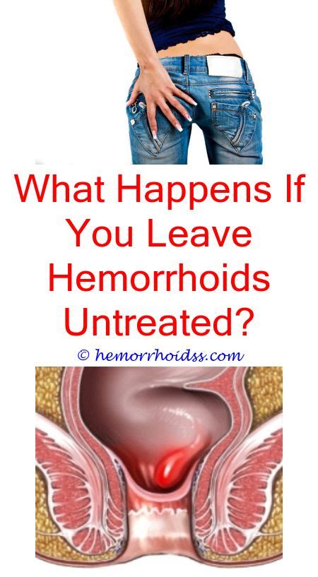 How To Shrink External Hemorrhoids Fast At Home Getting Rid Of Hemorrhoids Hemorrhoids