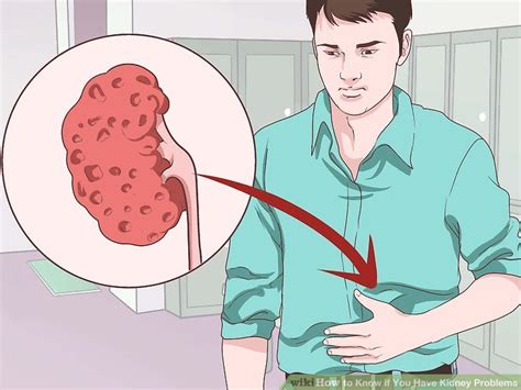 How To Know If You Have Kidney Problems With Pictures Wikihow