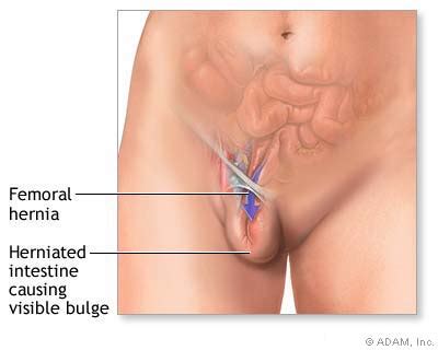 The New York Times Health Image Femoral Hernia