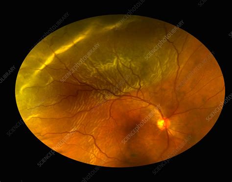 Retinal Detachment Stock Image C0271444 Science Photo Library