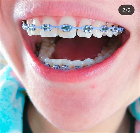 follow ya average girl for more pins ♛ light blue braces clear braces white braces dental