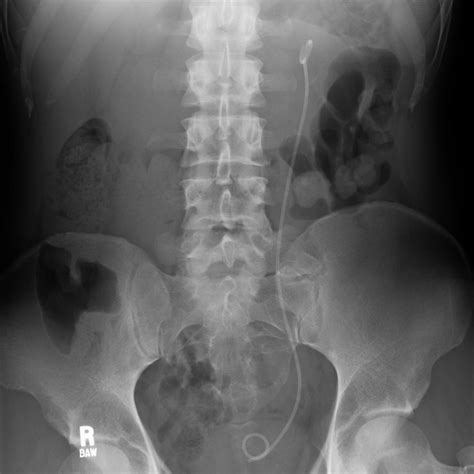 Abdominal X Ray Interpretation Axr Radiology Osce Geeky Medics