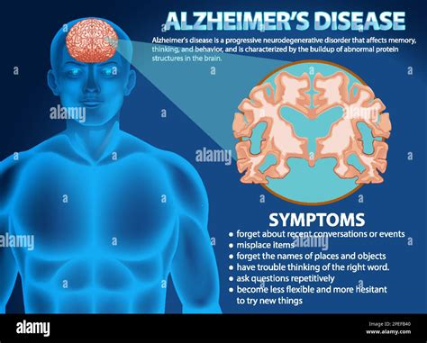 Informative Poster Of Alzheimers Disease Illustration Stock Vector