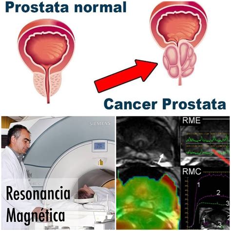 Resonancia para el cáncer de próstata Urología Peruana Dr Susaníbar