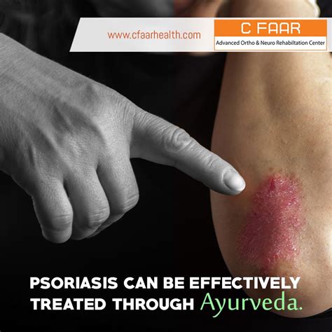 Best Ayurvedic Treatment For Psoriasis In India Psoriasis Ayurvedic