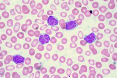 Chronic Lymphocytic Leukemia Cll — Staging And Prognosis Lecturio