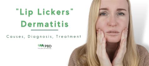 Lip Lickers Dermatitis Pinebelt Dermatology Ms
