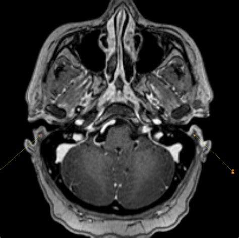 Ramsay Hunt Syndrome Image