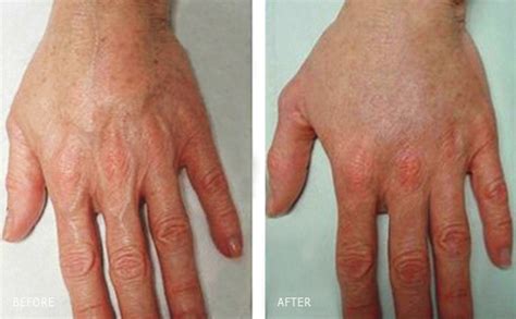 Hand Vein Removal Los Angeles Hand Rejuvenation Treatments