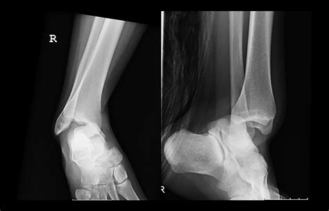 Pure Ankle Dislocation A Systematic Review Of The Literature And