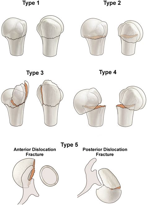 Classification Of Proximal Humeral Fractures Based On A